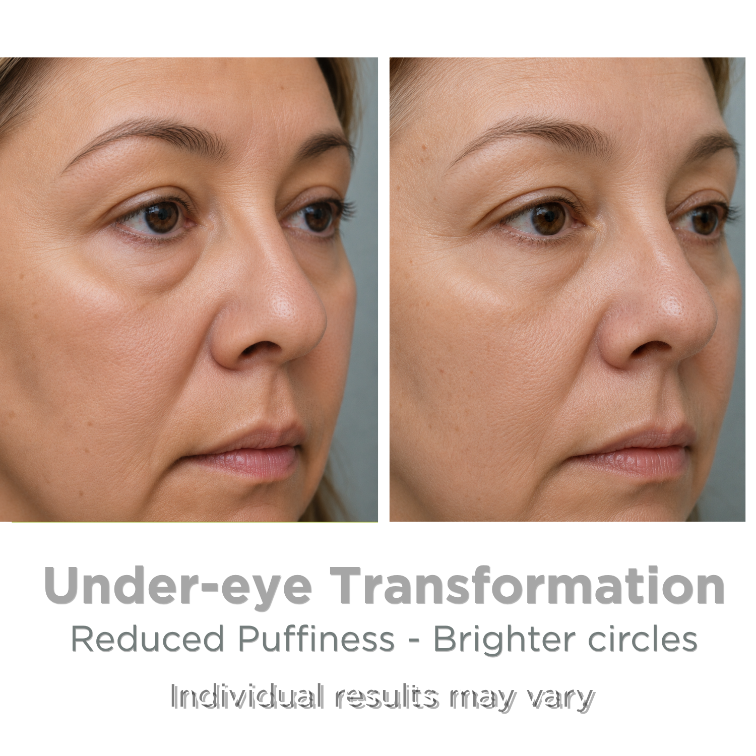 Cryotherapy skincare results
